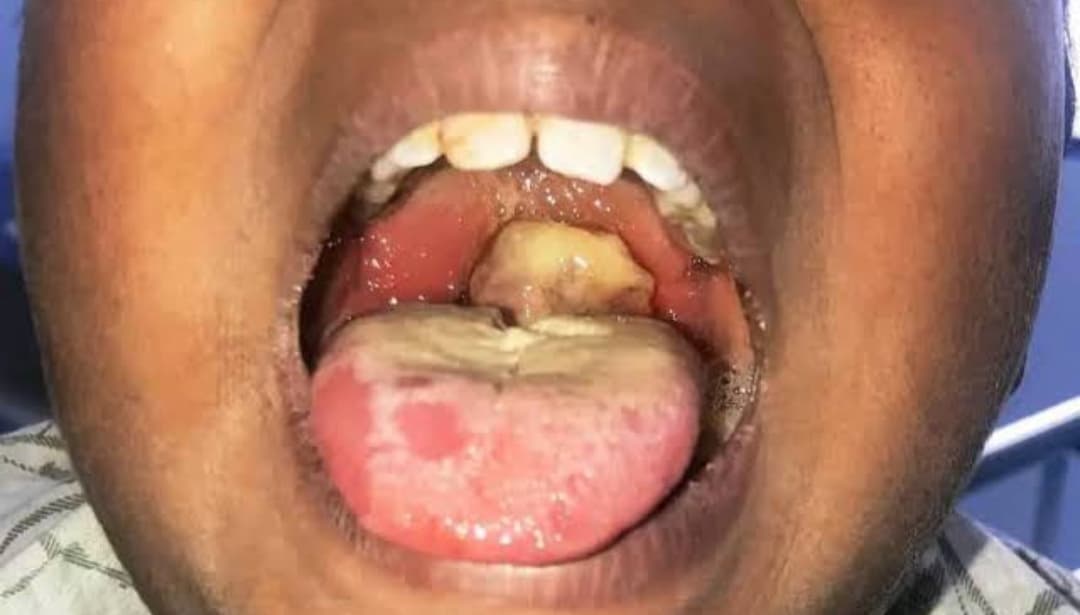 surge in suspected diphtheria infections.